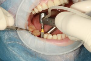 Close up of a dentist putting dental implants inside a mouth